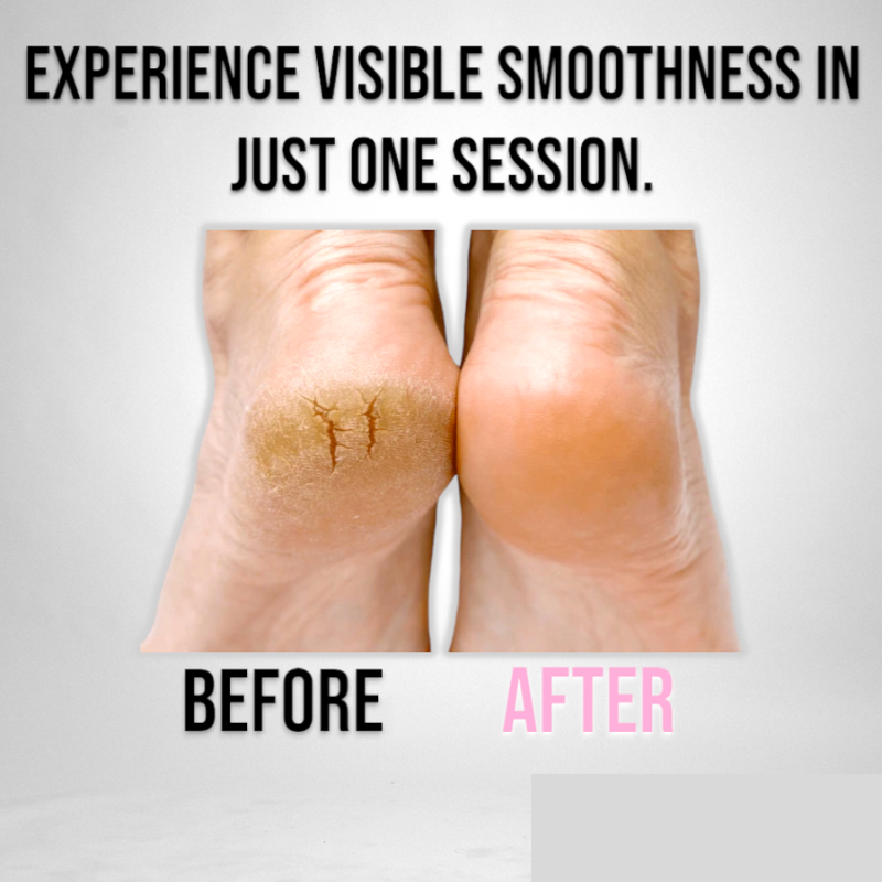 SmoothStep | Electric Foot Polisher
